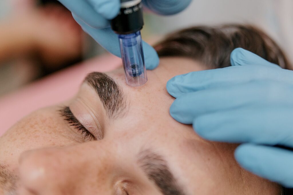 SkinPen Precision kezelés